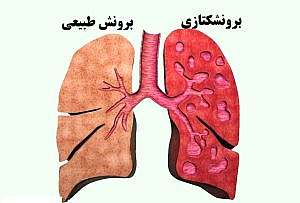 برونشکتازی