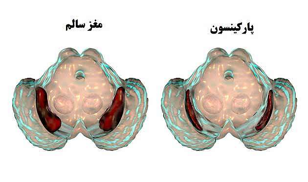 مغز یک فرد پارکینسونی