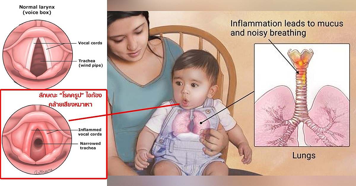 علائم تراکئیت؛ چه زمانی باید نگران شویم