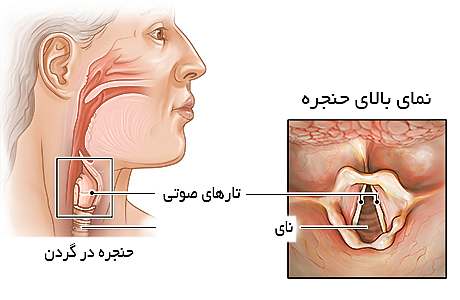 ادم حنجره چیست