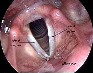 دلایل اصلی ایجاد ادم حنجره